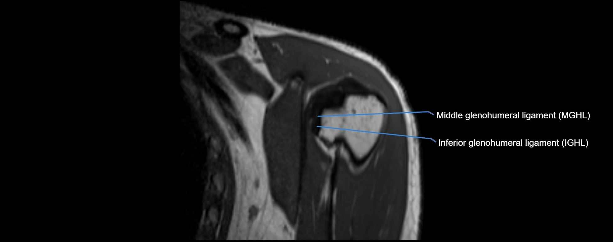 shoulder ligments coronal  cross sectional anatomy 3T MRI AI enhanced radiology image -img-00001-00007.webp